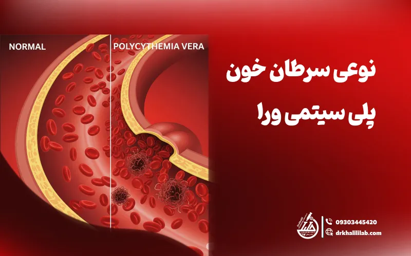 پلی سیتمی ورا — نوعی سرطان خون.